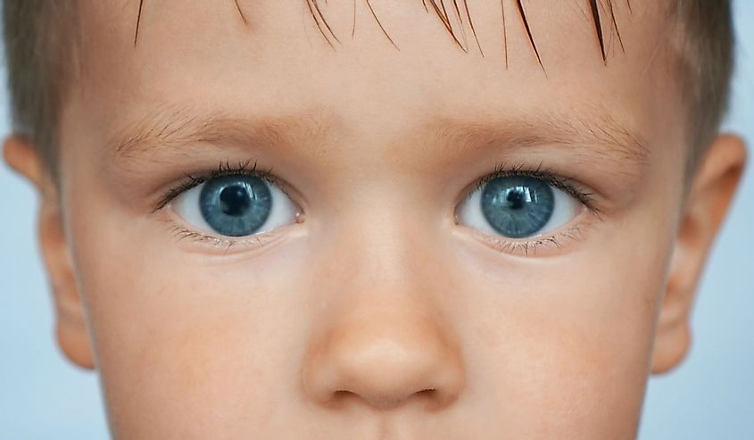 У ребенка голубые глаза с явлениями анизокории, зрачки разного размера.