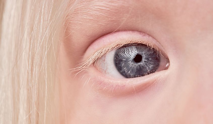 глаза ребенка-альбиноса